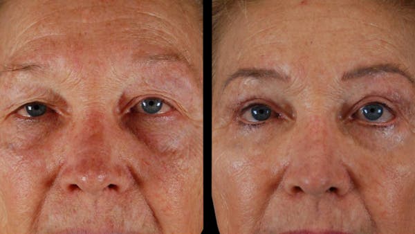 Upper & Lower Eyelid Surgery Before & After Gallery - Patient 129074 - Image 1