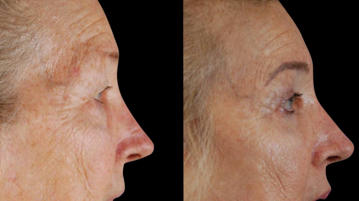 Upper & Lower Eyelid Surgery Before & After Gallery - Patient 129074 - Image 3