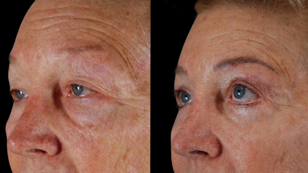 Upper & Lower Eyelid Surgery Before & After Gallery - Patient 129074 - Image 4