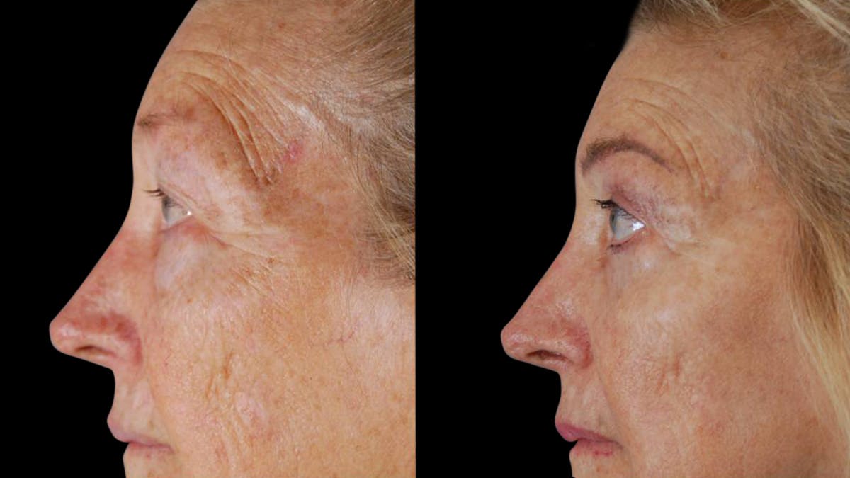 Upper & Lower Eyelid Surgery Before & After Gallery - Patient 129074 - Image 5