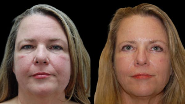 Upper & Lower Eyelid Surgery Before & After Gallery - Patient 423265 - Image 1