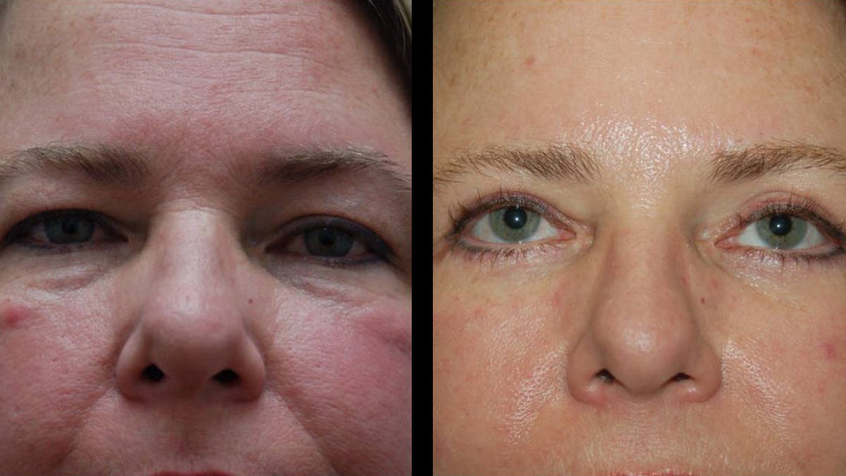 Upper & Lower Eyelid Surgery Before & After Gallery - Patient 423265 - Image 2