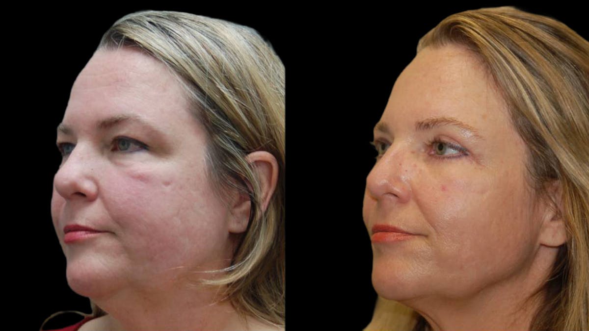 Upper & Lower Eyelid Surgery Before & After Gallery - Patient 423265 - Image 3