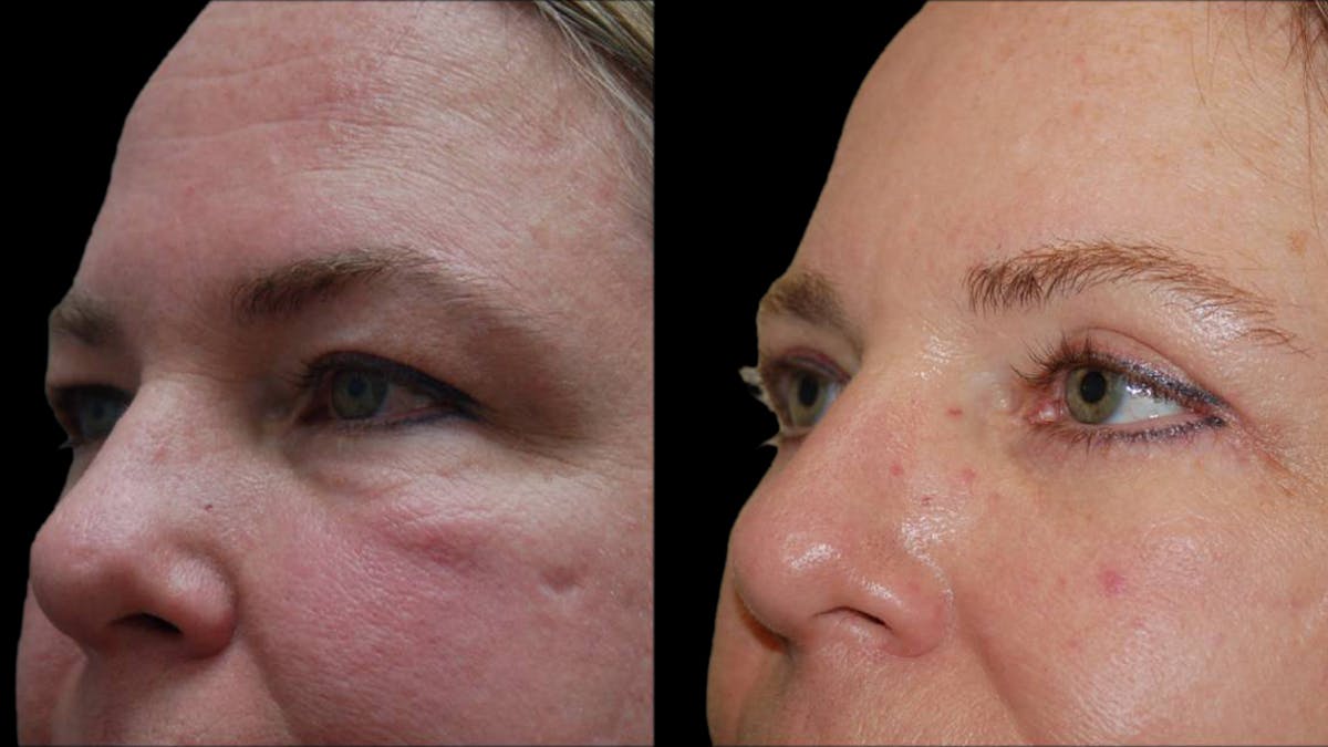 Upper & Lower Eyelid Surgery Before & After Gallery - Patient 423265 - Image 4