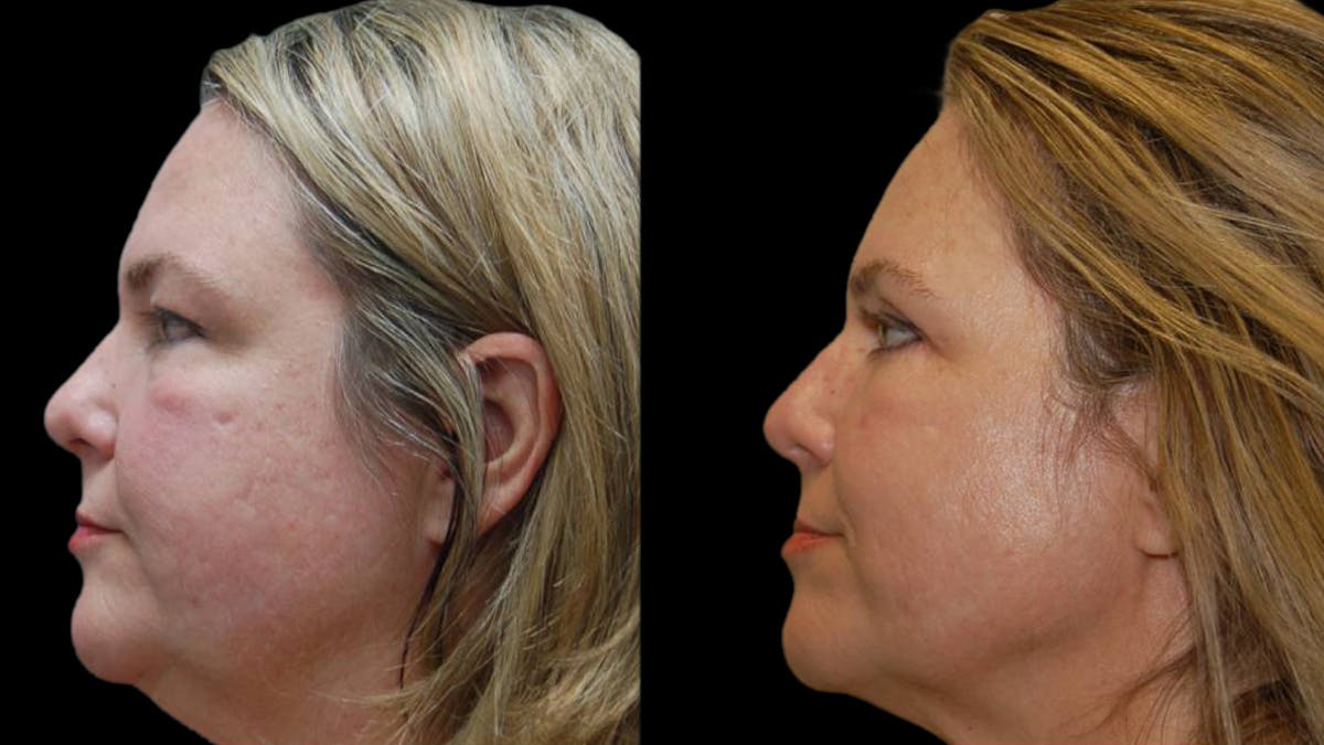 Upper & Lower Eyelid Surgery Before & After Gallery - Patient 423265 - Image 5