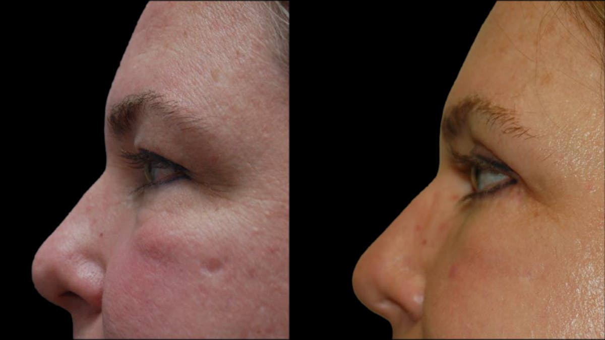 Upper & Lower Eyelid Surgery Before & After Gallery - Patient 423265 - Image 6
