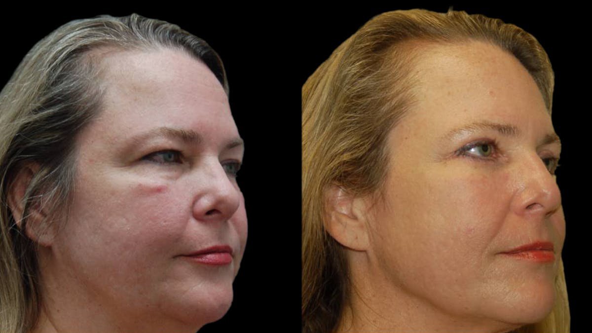 Upper & Lower Eyelid Surgery Before & After Gallery - Patient 423265 - Image 7