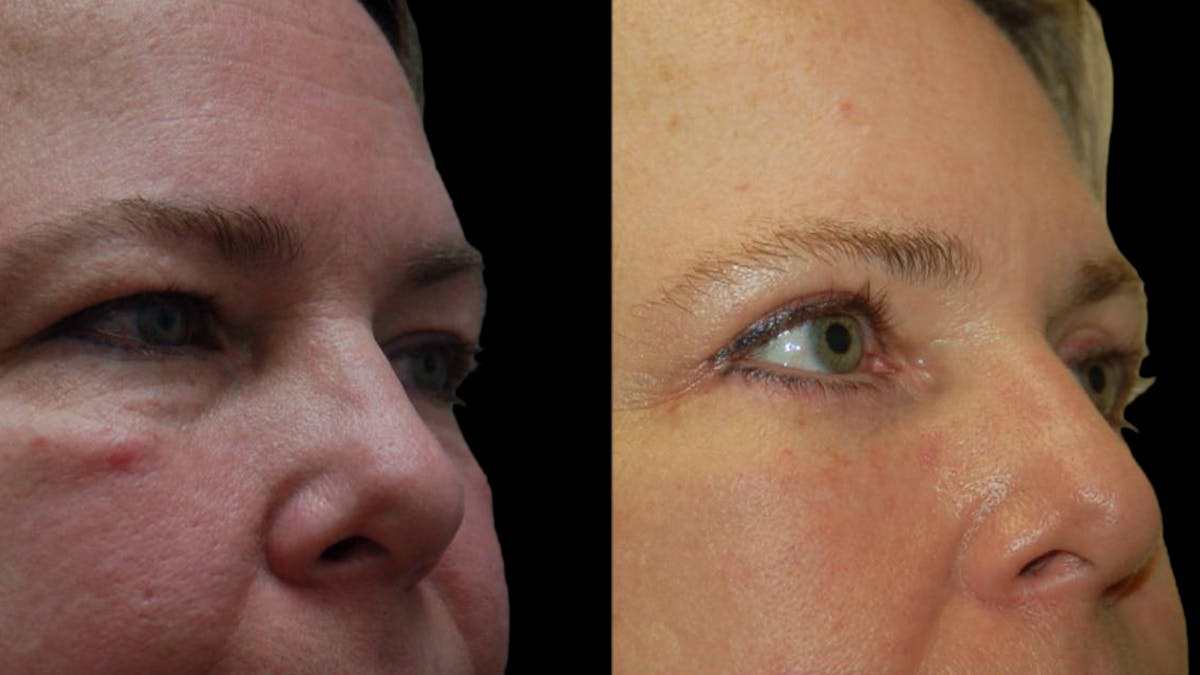 Upper & Lower Eyelid Surgery Before & After Gallery - Patient 423265 - Image 8