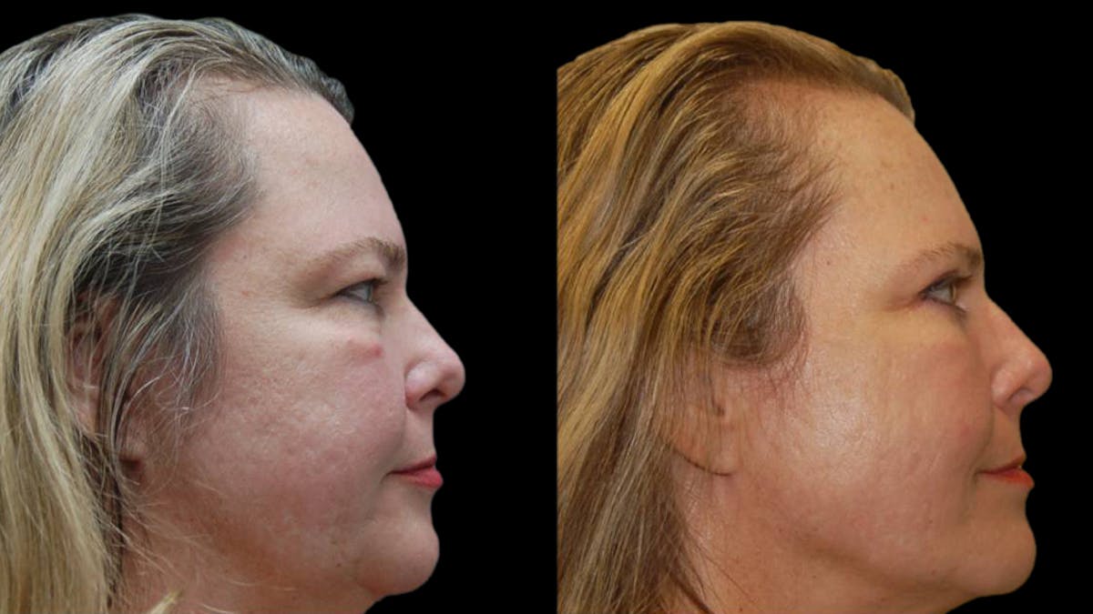 Upper & Lower Eyelid Surgery Before & After Gallery - Patient 423265 - Image 9