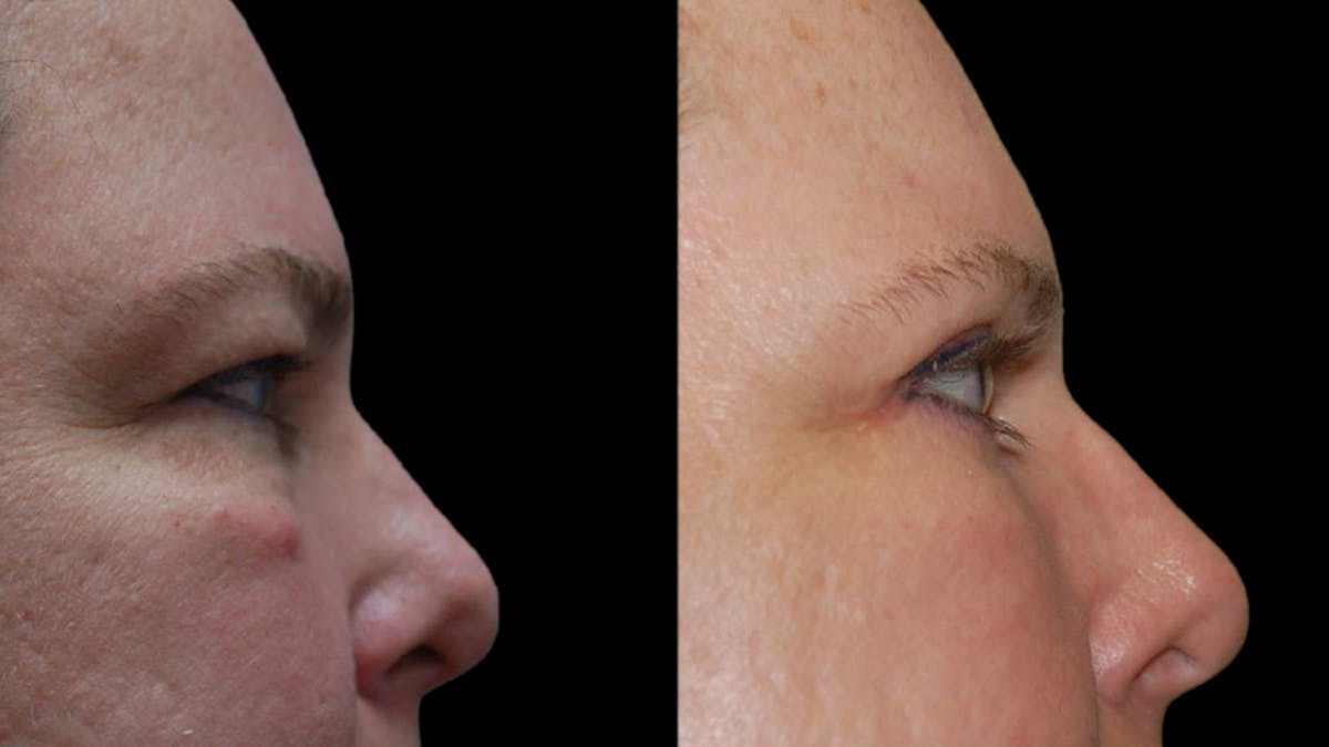 Upper & Lower Eyelid Surgery Before & After Gallery - Patient 423265 - Image 10