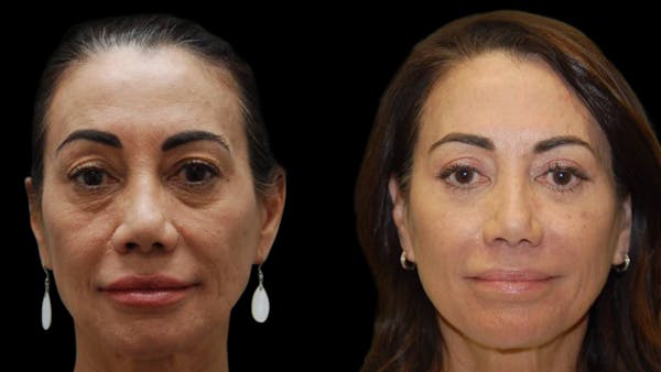 Upper & Lower Eyelid Surgery Before & After Gallery - Patient 202475 - Image 1