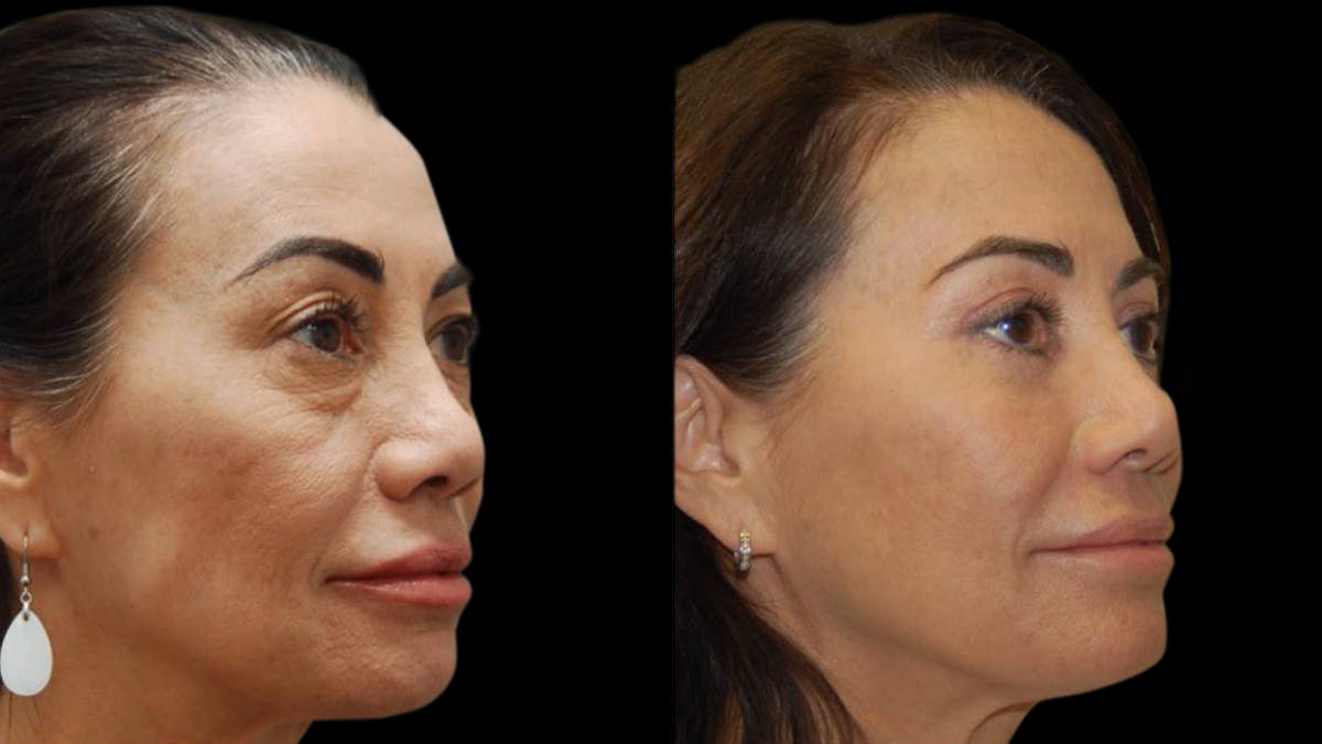 Upper & Lower Eyelid Surgery Before & After Gallery - Patient 202475 - Image 2