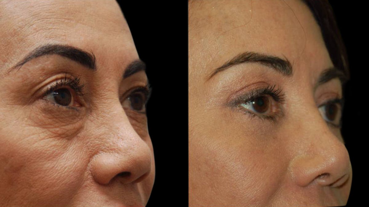 Upper & Lower Eyelid Surgery Before & After Gallery - Patient 202475 - Image 3