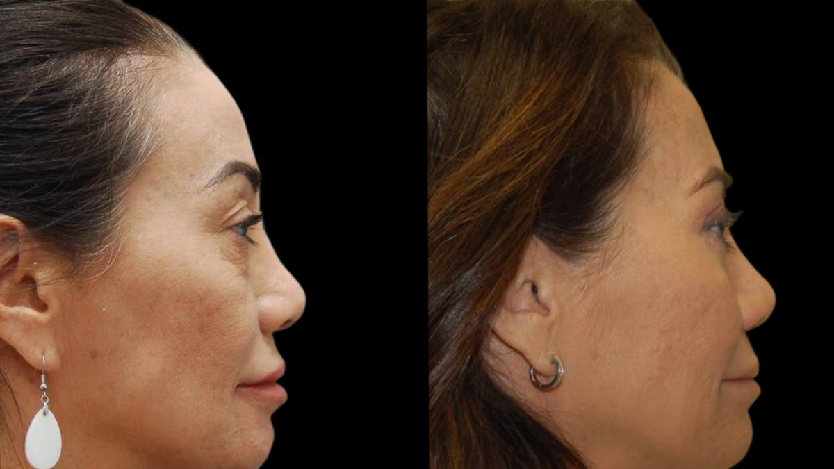 Upper & Lower Eyelid Surgery Before & After Gallery - Patient 202475 - Image 4