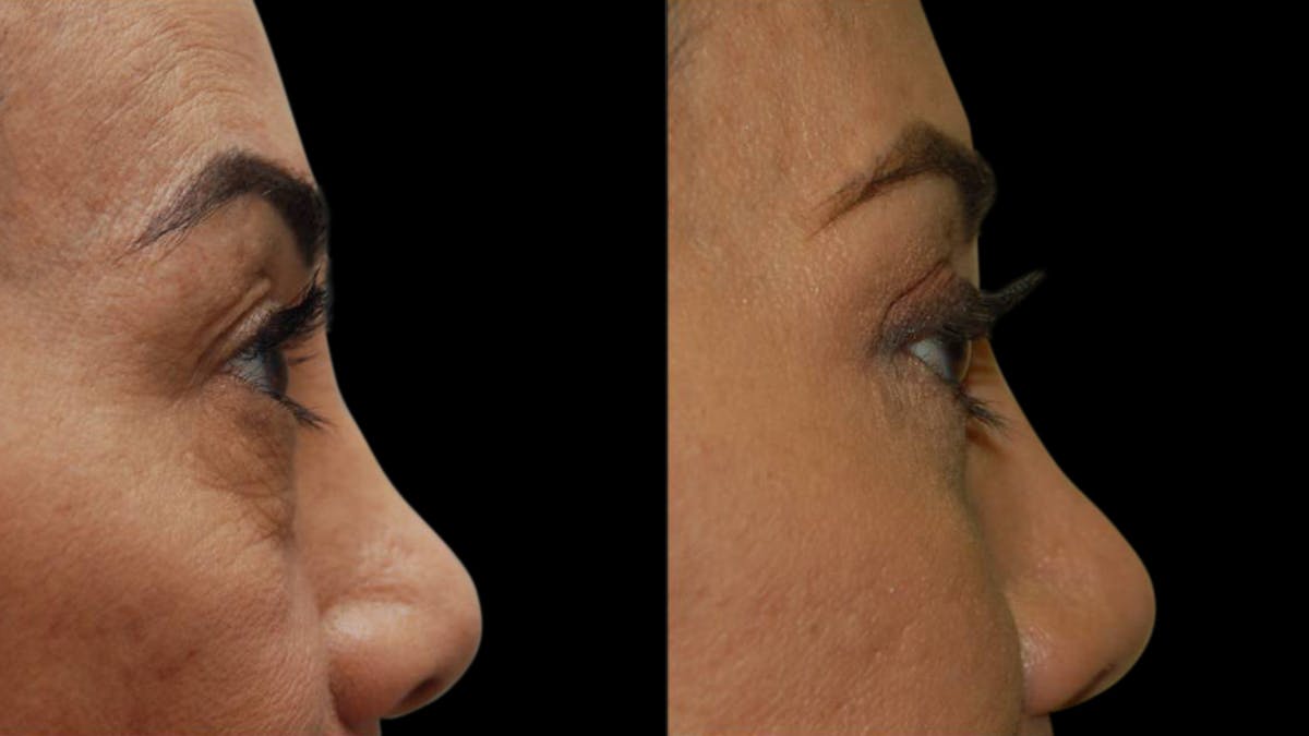 Upper & Lower Eyelid Surgery Before & After Gallery - Patient 202475 - Image 5