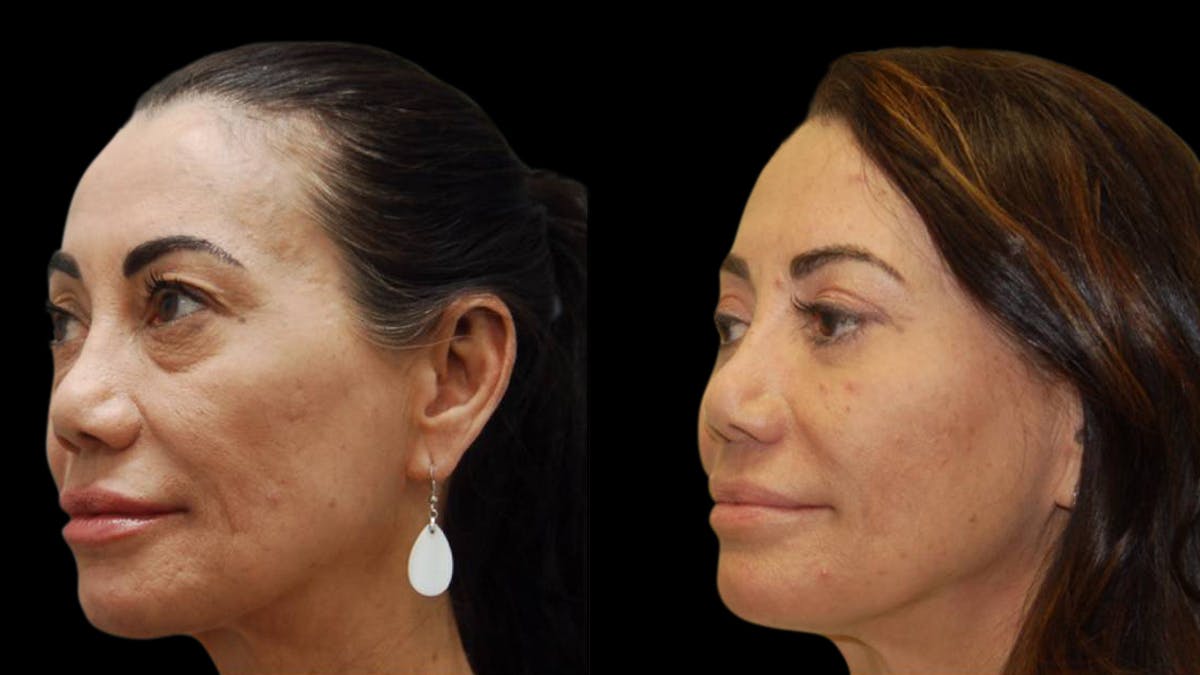 Upper & Lower Eyelid Surgery Before & After Gallery - Patient 202475 - Image 6