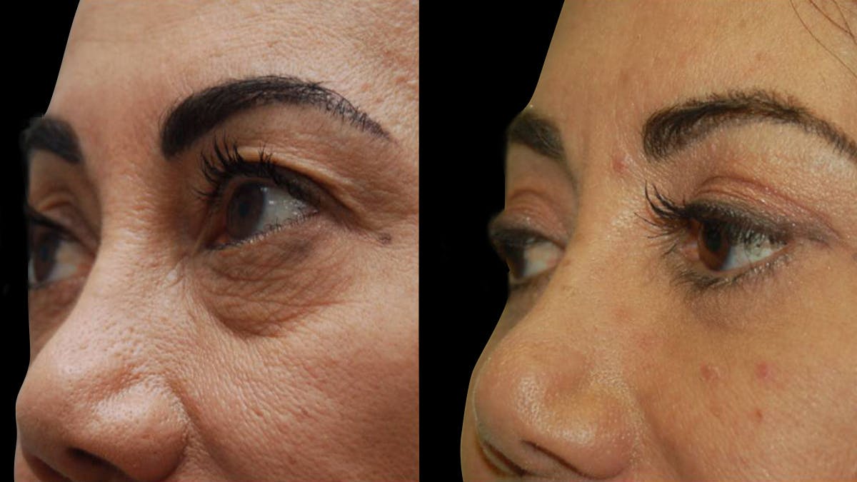 Upper & Lower Eyelid Surgery Before & After Gallery - Patient 202475 - Image 7