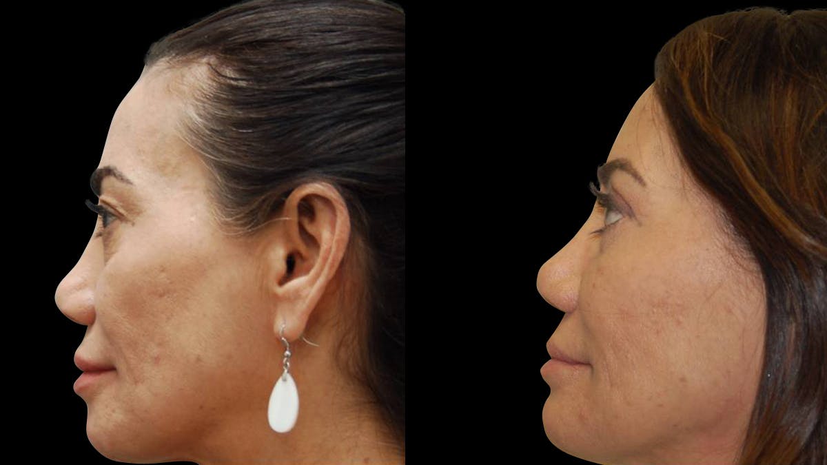 Upper & Lower Eyelid Surgery Before & After Gallery - Patient 202475 - Image 8