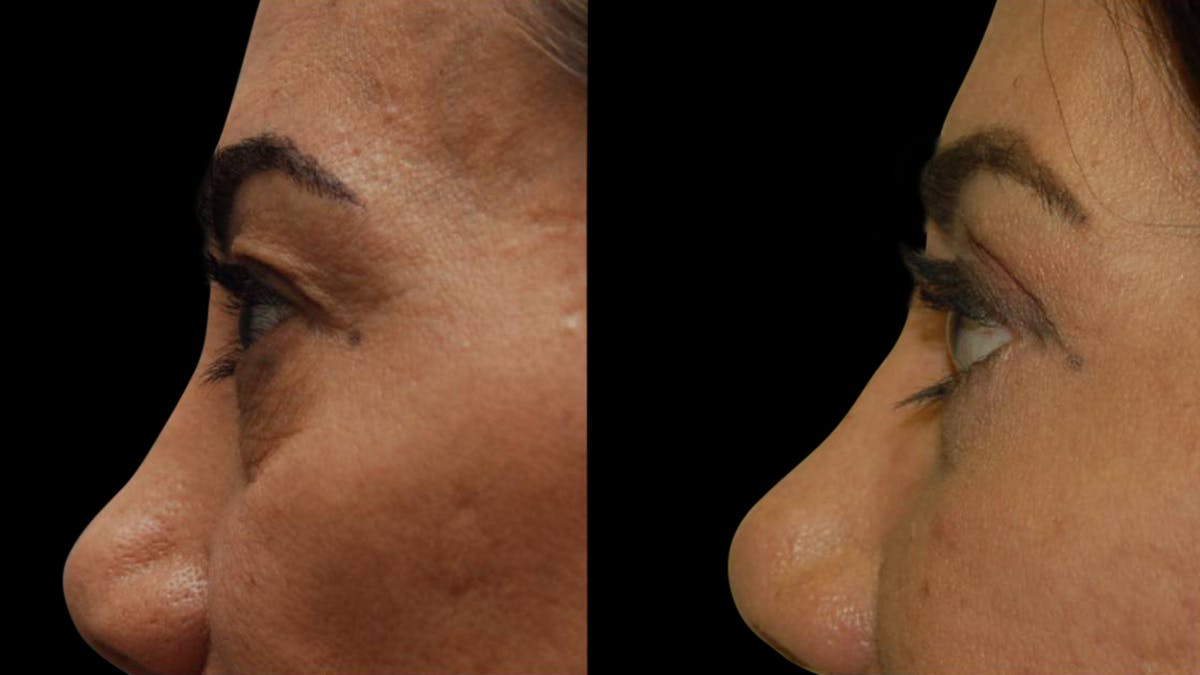 Upper & Lower Eyelid Surgery Before & After Gallery - Patient 202475 - Image 9