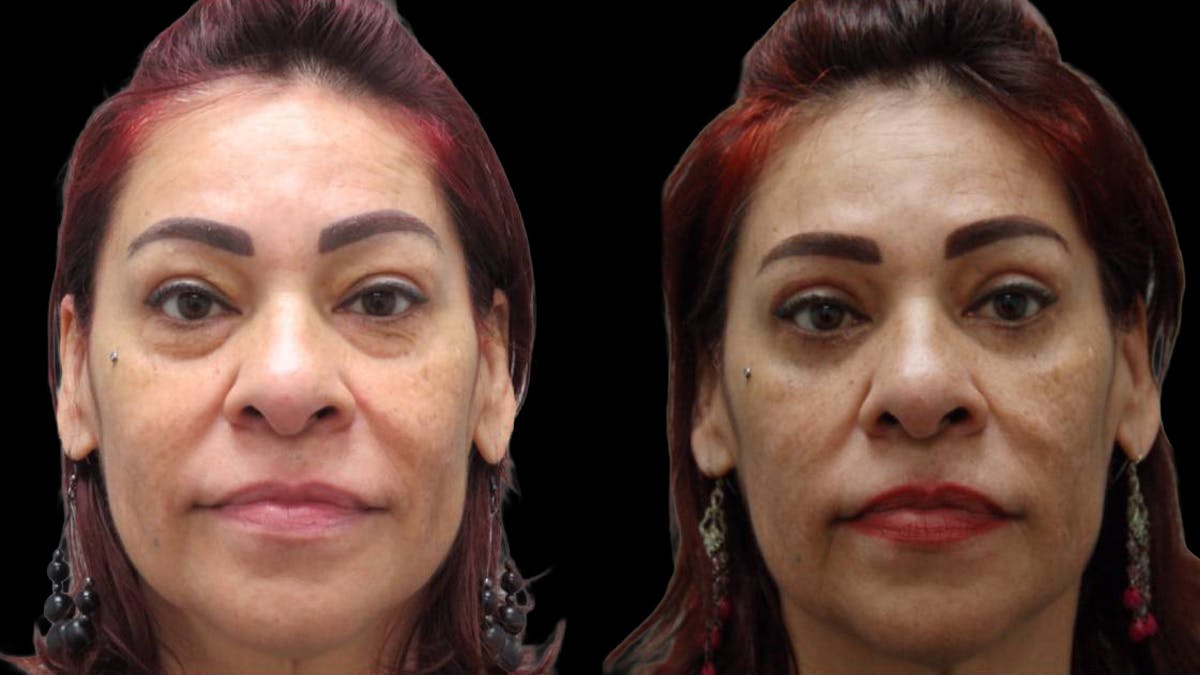 Upper & Lower Eyelid Surgery Before & After Gallery - Patient 777688 - Image 1