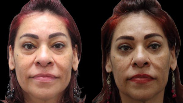 Upper & Lower Eyelid Surgery Before & After Gallery - Patient 777688 - Image 1