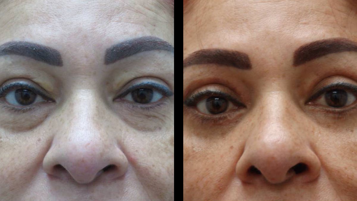 Upper & Lower Eyelid Surgery Before & After Gallery - Patient 777688 - Image 2