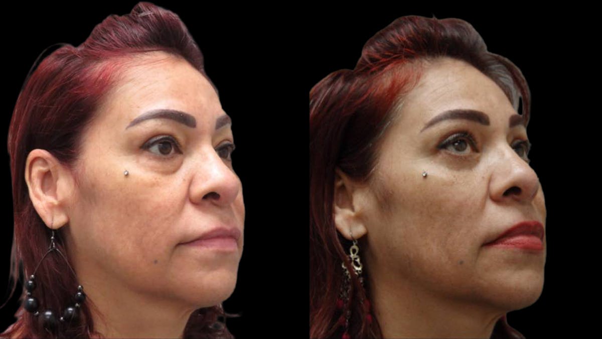 Upper & Lower Eyelid Surgery Before & After Gallery - Patient 777688 - Image 3