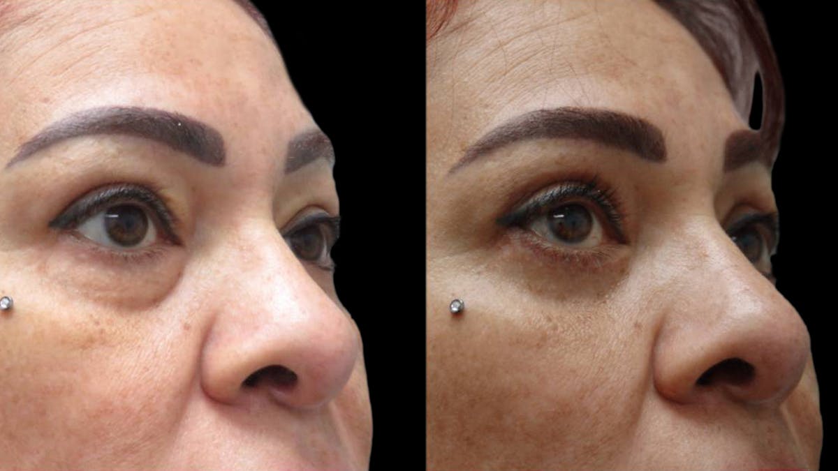 Upper & Lower Eyelid Surgery Before & After Gallery - Patient 777688 - Image 4