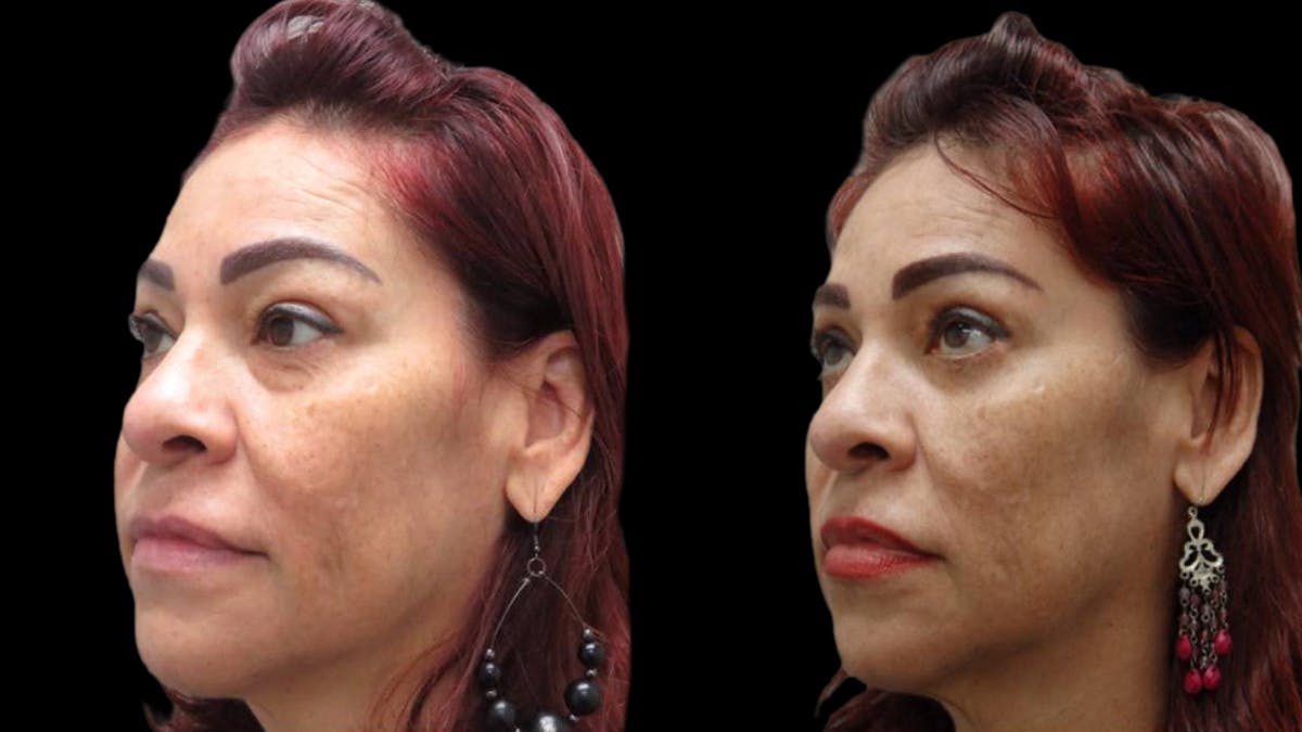 Upper & Lower Eyelid Surgery Before & After Gallery - Patient 777688 - Image 5