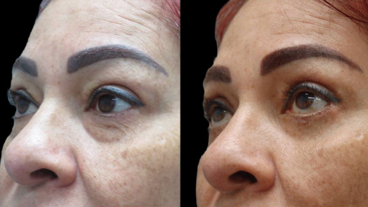 Upper & Lower Eyelid Surgery Before & After Gallery - Patient 777688 - Image 6