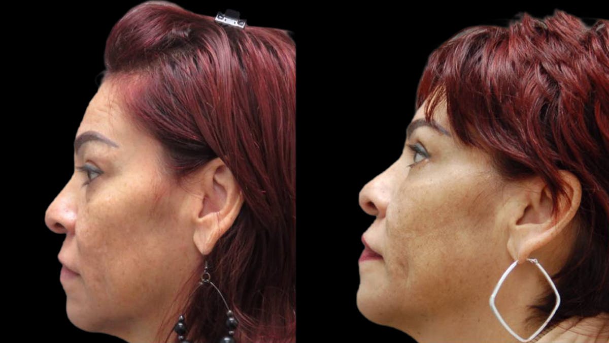 Upper & Lower Eyelid Surgery Before & After Gallery - Patient 777688 - Image 7