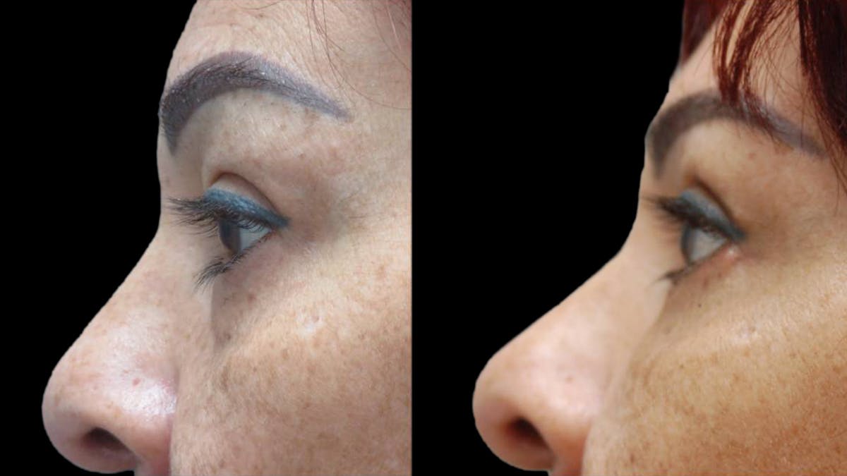 Upper & Lower Eyelid Surgery Before & After Gallery - Patient 777688 - Image 8