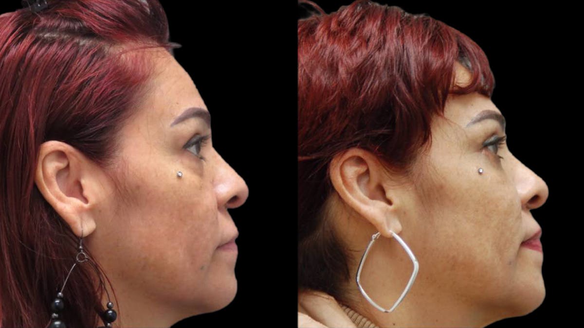 Upper & Lower Eyelid Surgery Before & After Gallery - Patient 777688 - Image 9