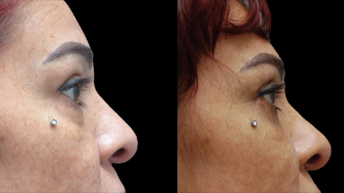 Upper & Lower Eyelid Surgery Before & After Gallery - Patient 777688 - Image 10