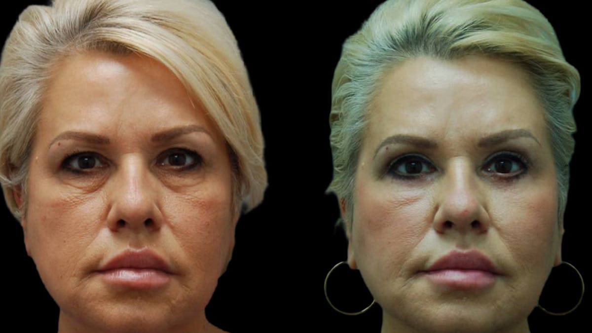 Upper & Lower Eyelid Surgery Before & After Gallery - Patient 123284 - Image 1