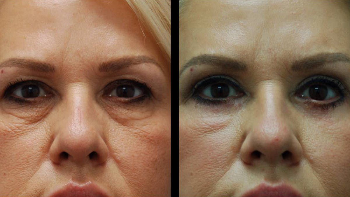 Upper & Lower Eyelid Surgery Before & After Gallery - Patient 123284 - Image 2