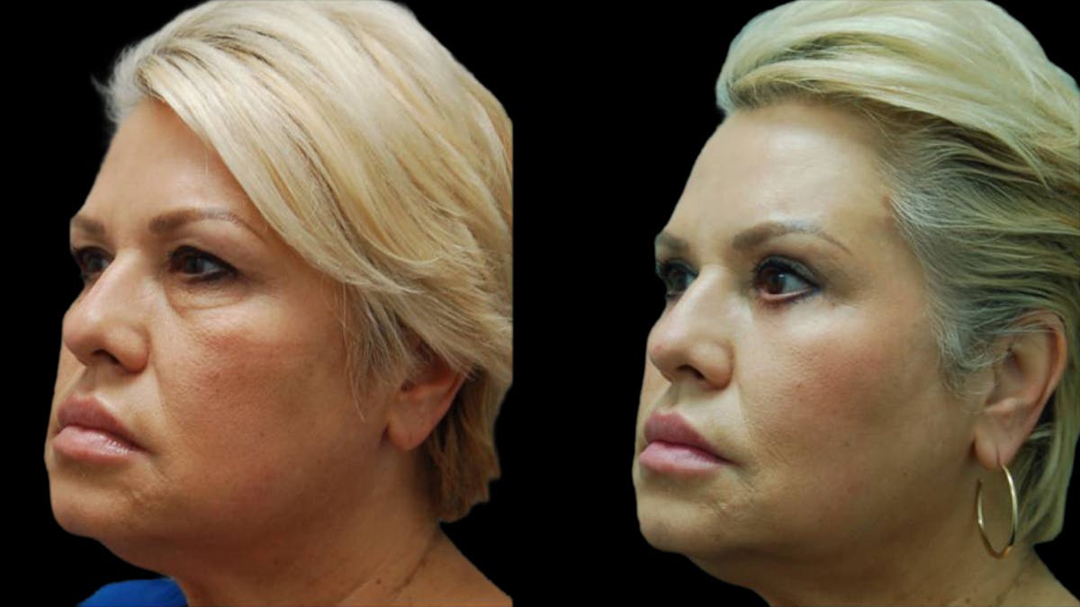 Upper & Lower Eyelid Surgery Before & After Gallery - Patient 123284 - Image 3