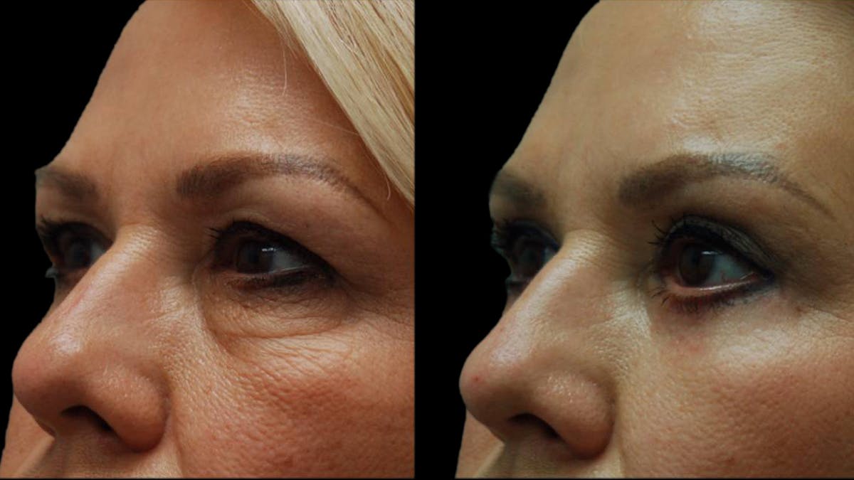 Upper & Lower Eyelid Surgery Before & After Gallery - Patient 123284 - Image 4
