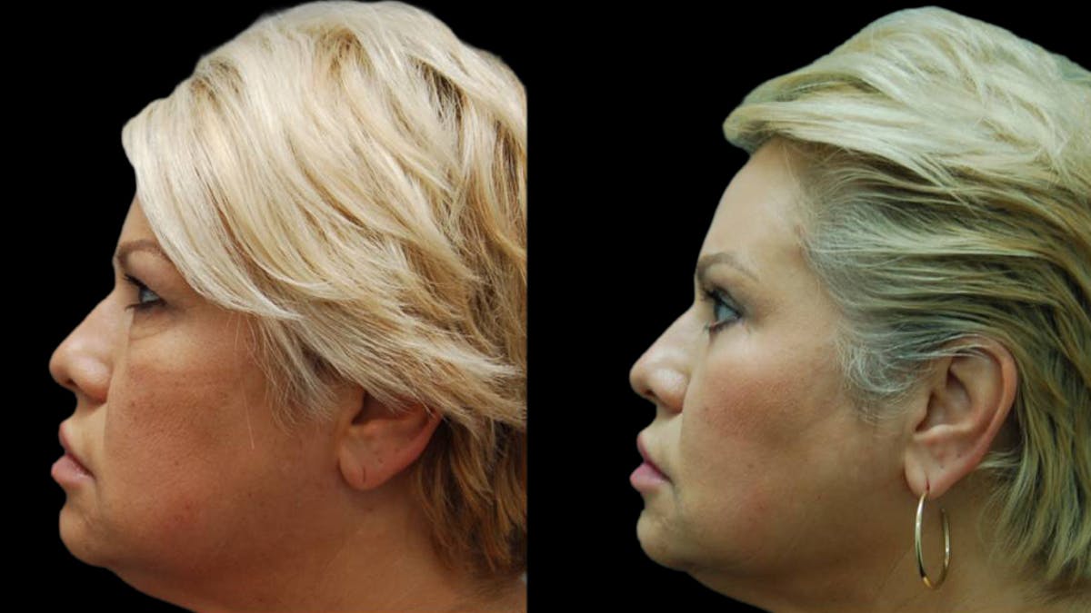 Upper & Lower Eyelid Surgery Before & After Gallery - Patient 123284 - Image 5