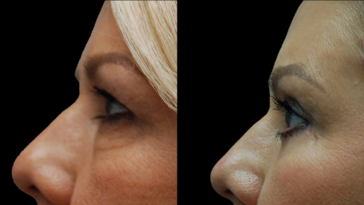 Upper & Lower Eyelid Surgery Before & After Gallery - Patient 123284 - Image 6