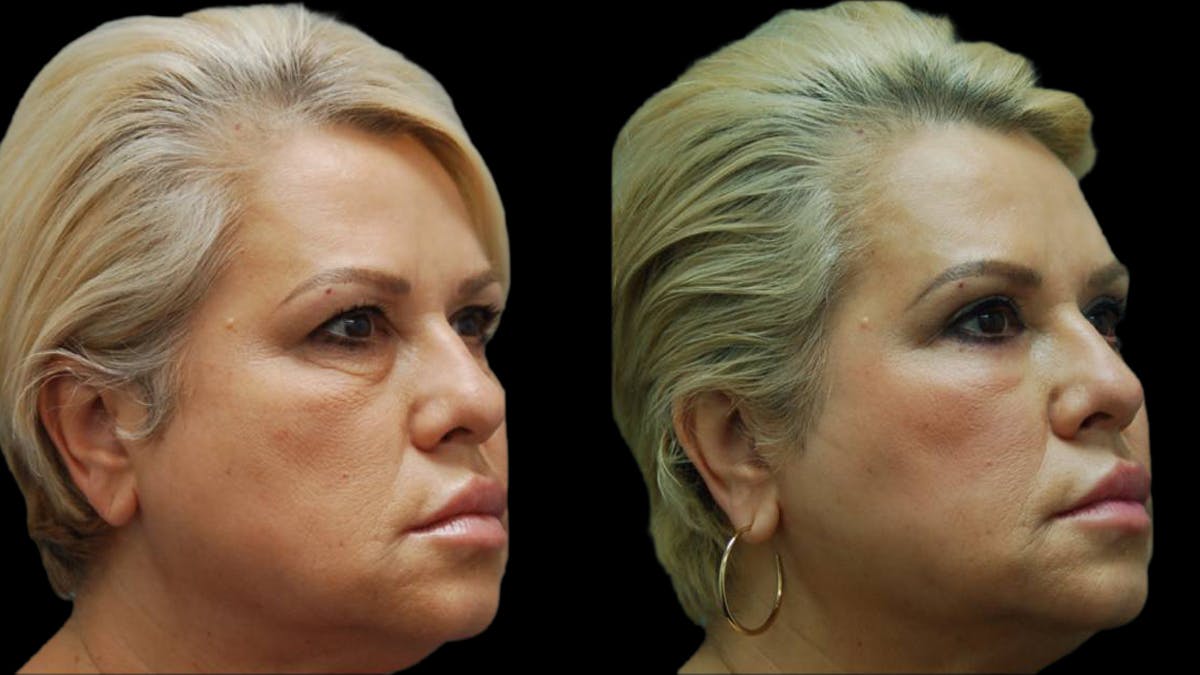 Upper & Lower Eyelid Surgery Before & After Gallery - Patient 123284 - Image 7
