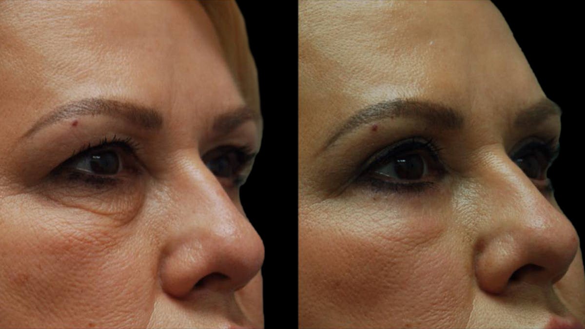 Upper & Lower Eyelid Surgery Before & After Gallery - Patient 123284 - Image 8