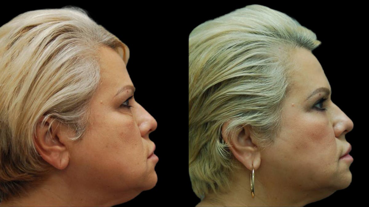 Upper & Lower Eyelid Surgery Before & After Gallery - Patient 123284 - Image 9