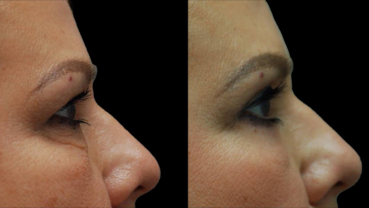 Upper & Lower Eyelid Surgery Before & After Gallery - Patient 123284 - Image 10