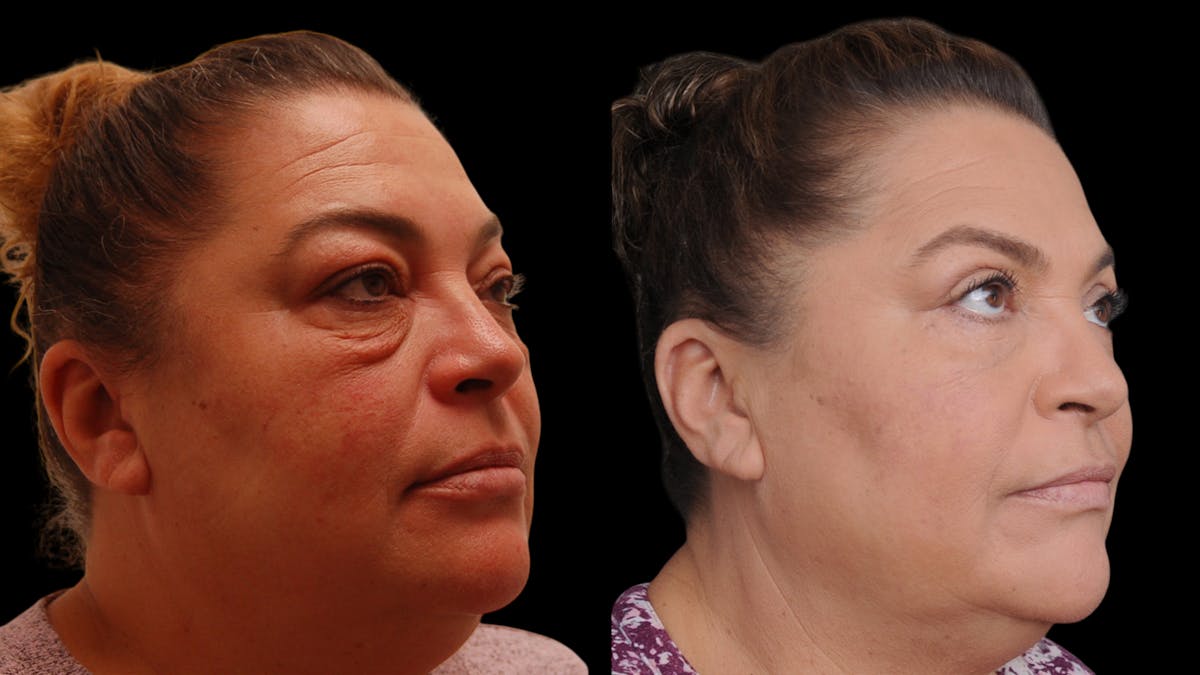 Upper & Lower Eyelid Surgery Before & After Gallery - Patient 156492 - Image 1