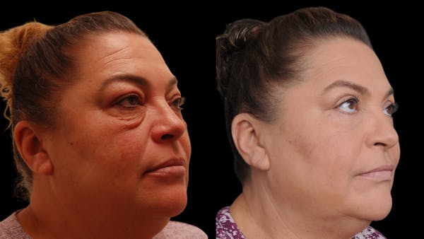 Upper & Lower Eyelid Surgery Before & After Gallery - Patient 156492 - Image 1