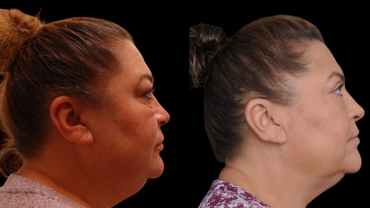 Upper & Lower Eyelid Surgery Before & After Gallery - Patient 156492 - Image 2