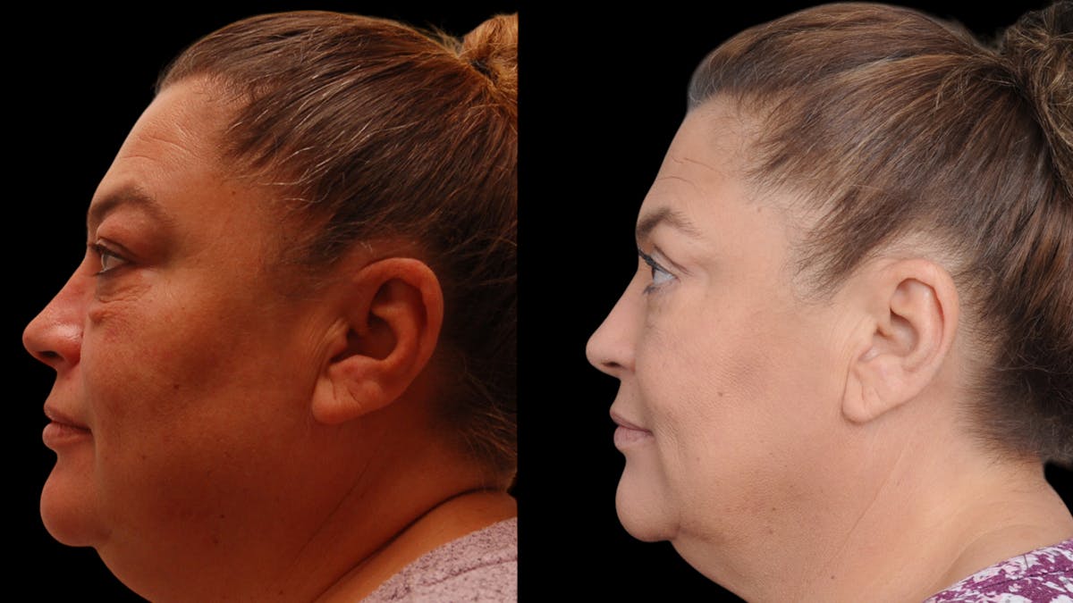 Upper & Lower Eyelid Surgery Before & After Gallery - Patient 156492 - Image 3