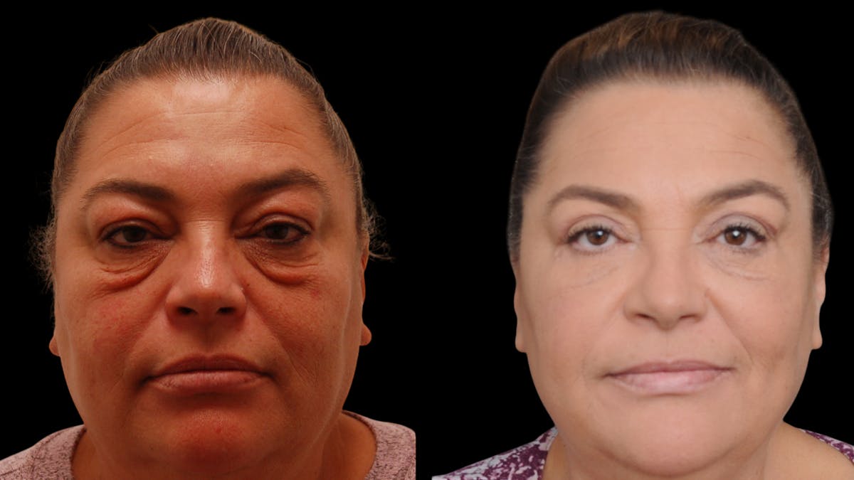 Upper & Lower Eyelid Surgery Before & After Gallery - Patient 156492 - Image 4