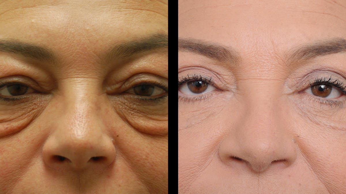Upper & Lower Eyelid Surgery Before & After Gallery - Patient 156492 - Image 5